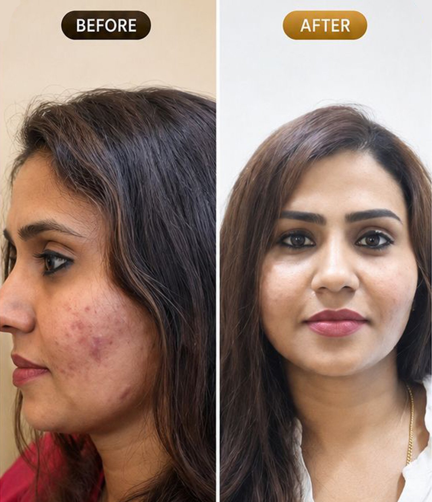 Acne Scar Treatment