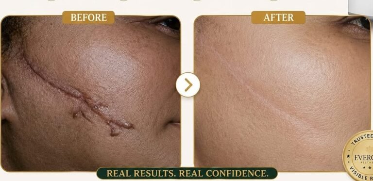 Ance Scar Removal Treatment