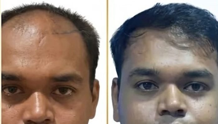 Hair Fall Treatment